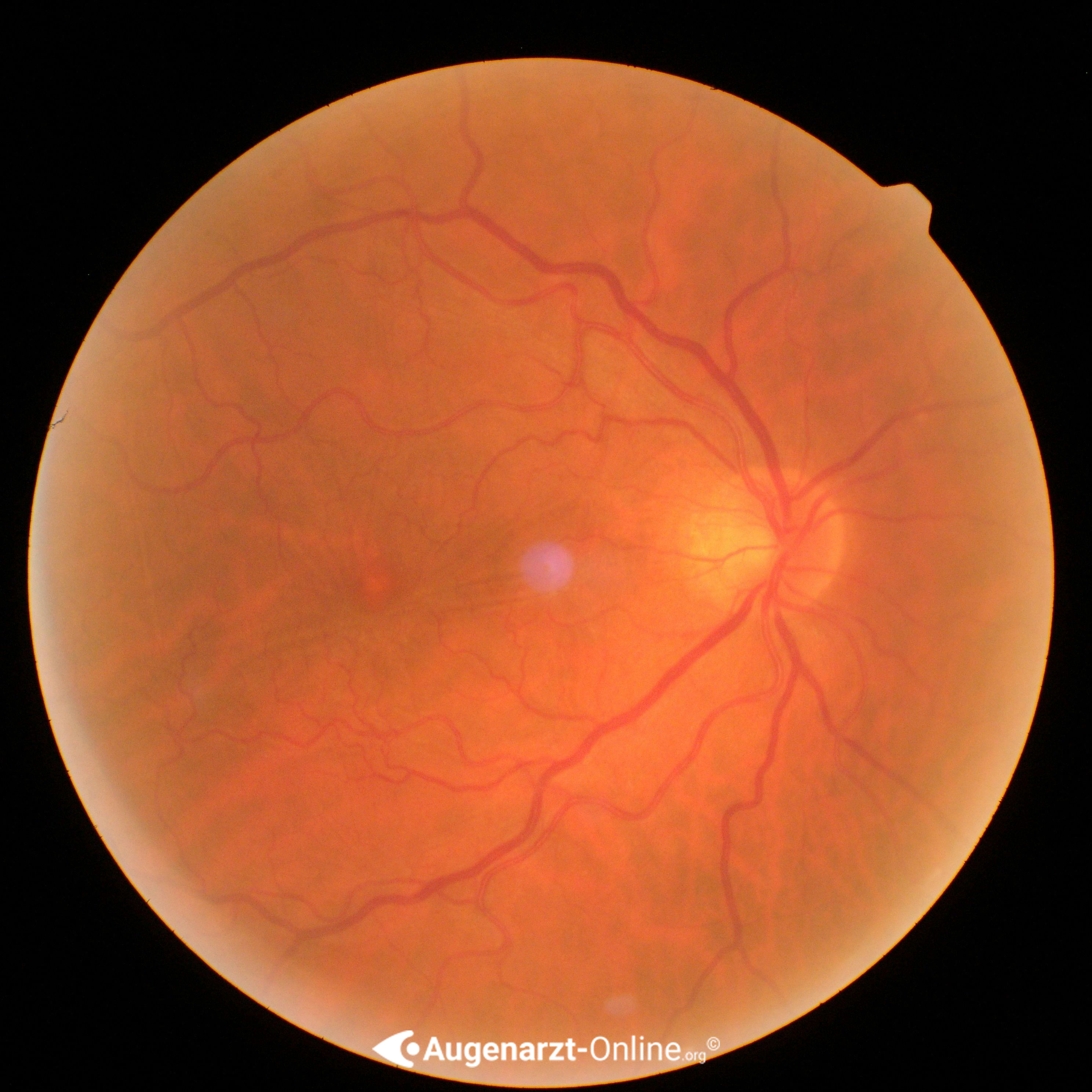 Epiretinale Gliose | Atlas der Augenheilkunde